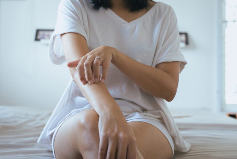 psoriasis