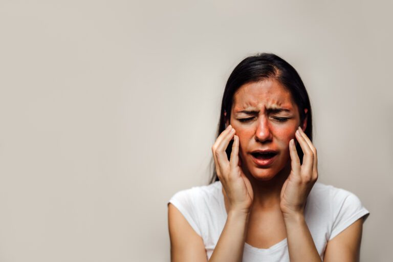 Seborrheic Dermatitis