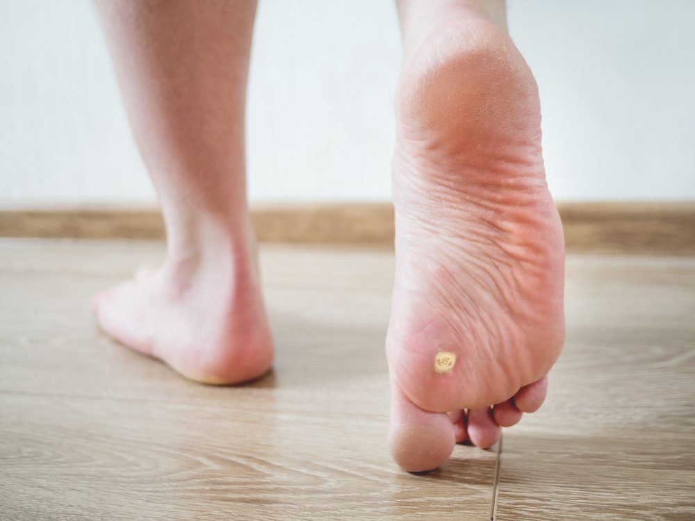 plantar-wart condition