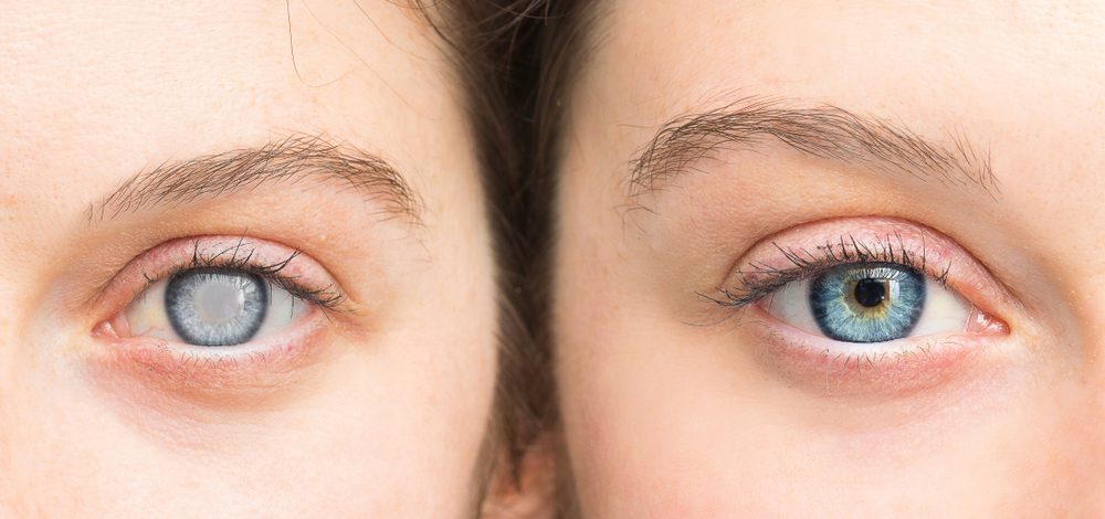 cataracts
