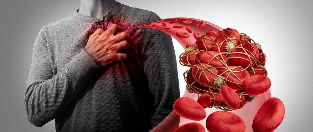 blood clot, covid