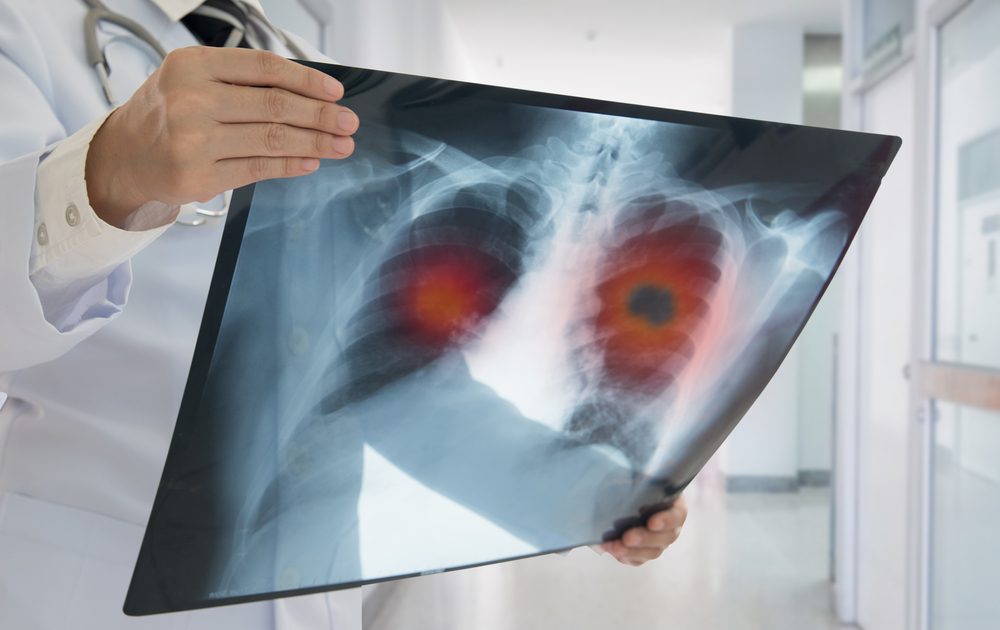 cancer symptoms, blood clot, early stage