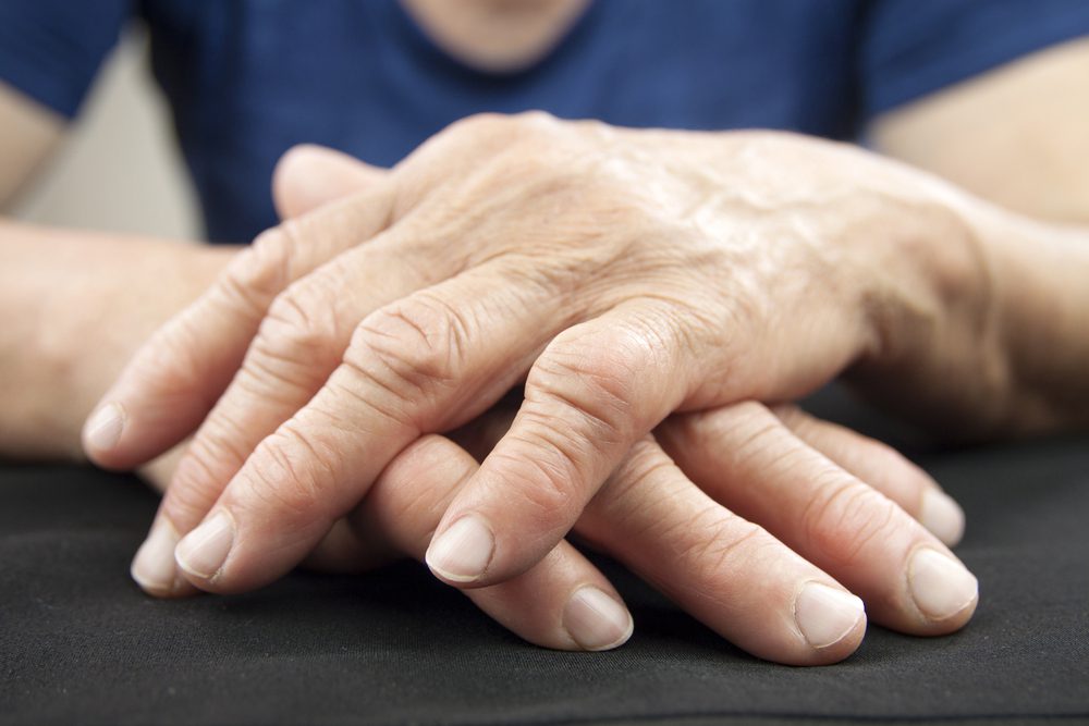 rheumatoid arthritis