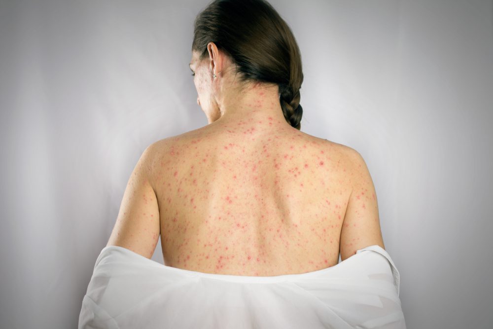rubella