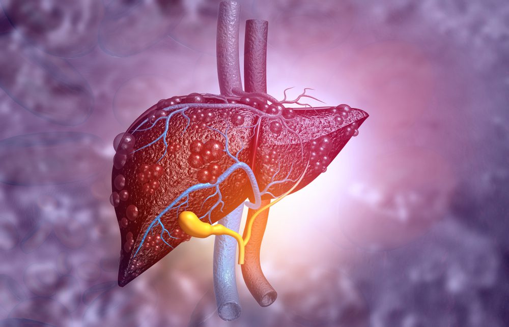 sugar, where cancer spreads
