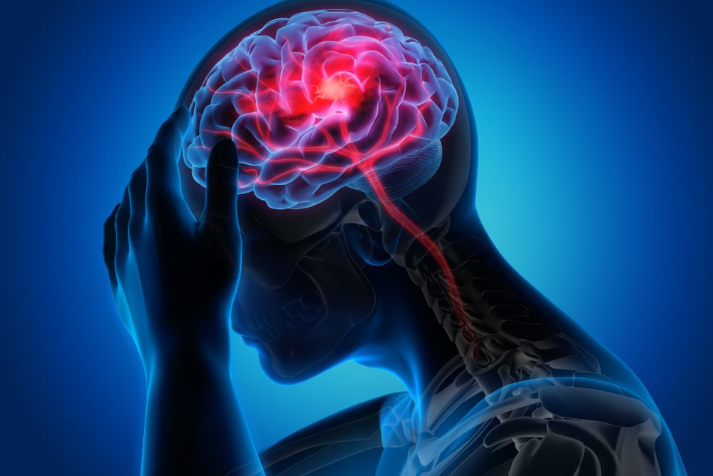 Migraine