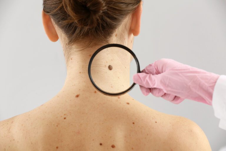 Moles