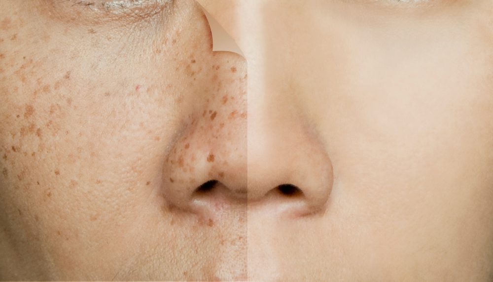 Moles