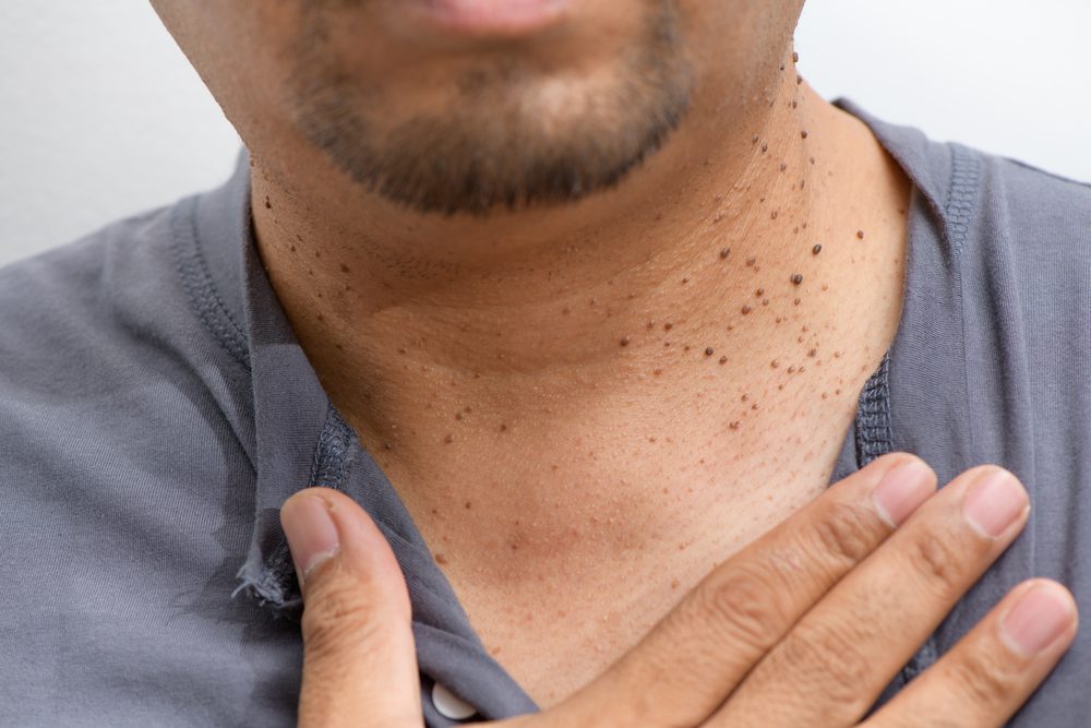 Moles