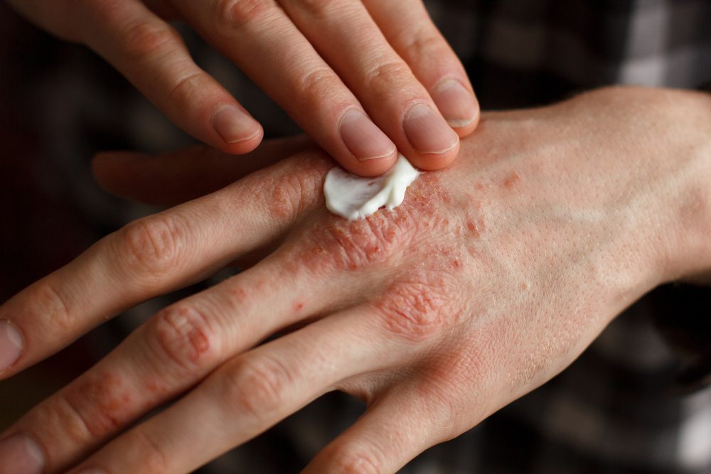 Psoriasis