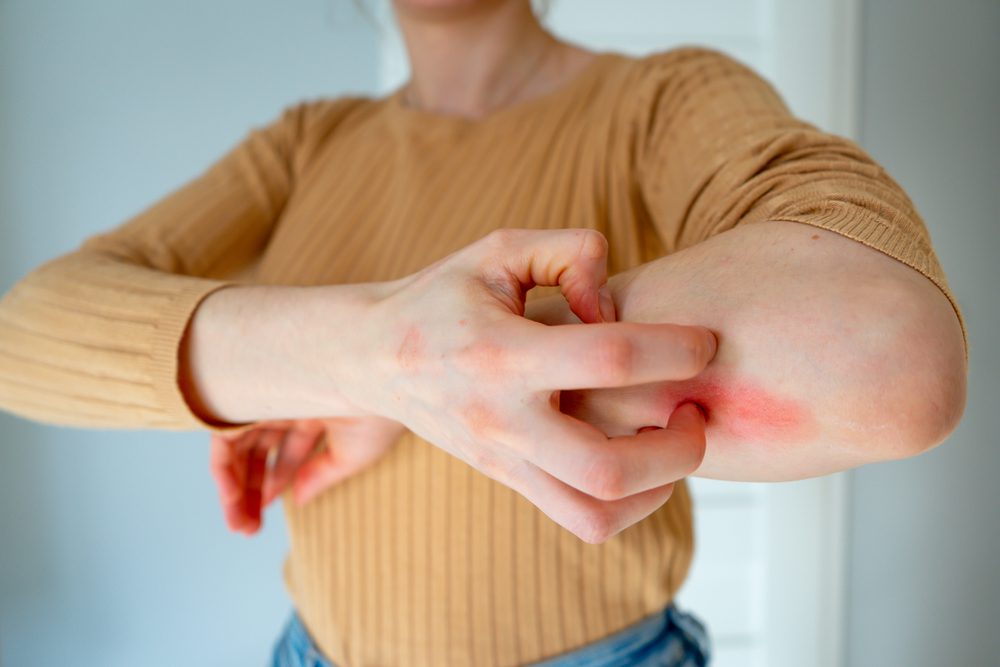 Psoriasis