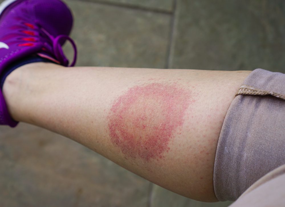 Tick Bites