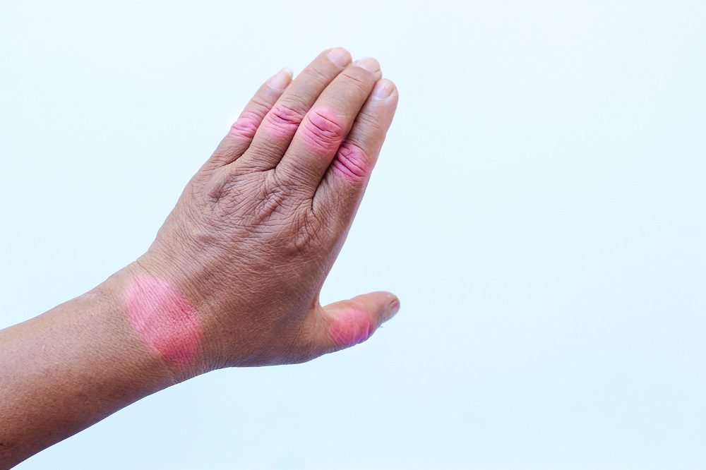 hand pain