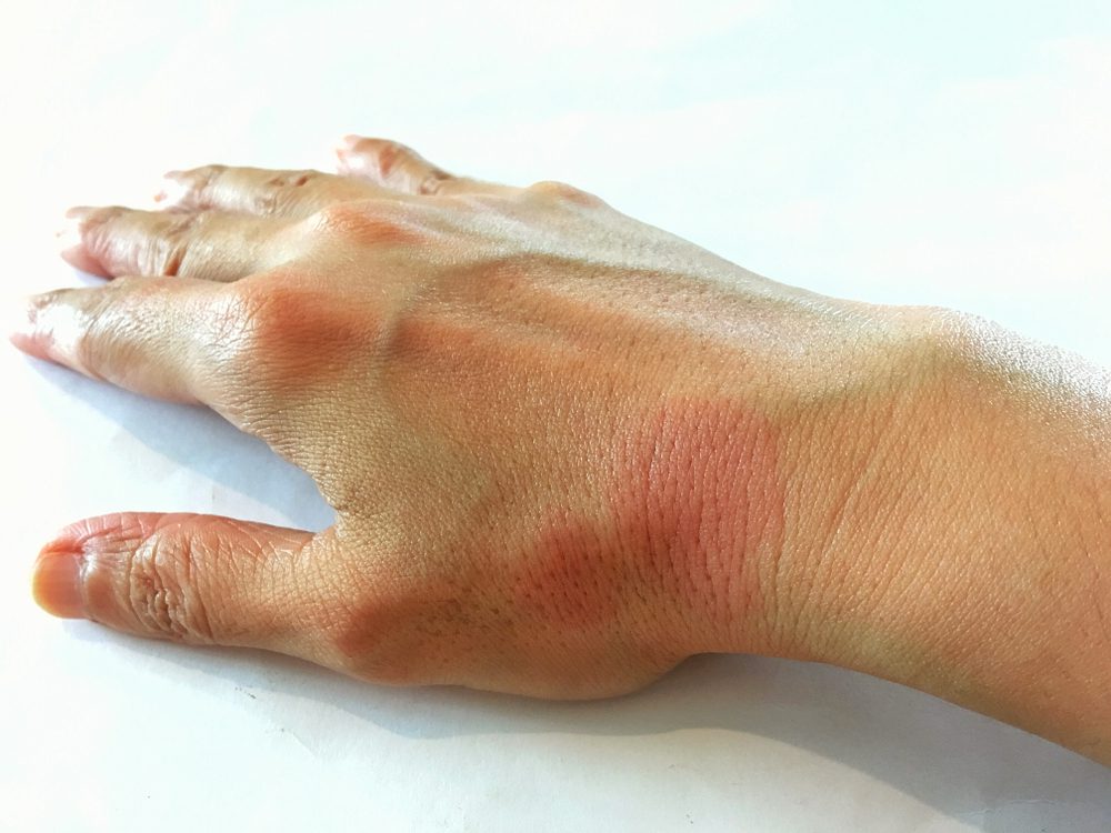 hand pain