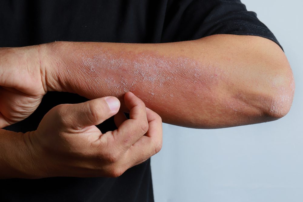 Dry skin and vitamin C