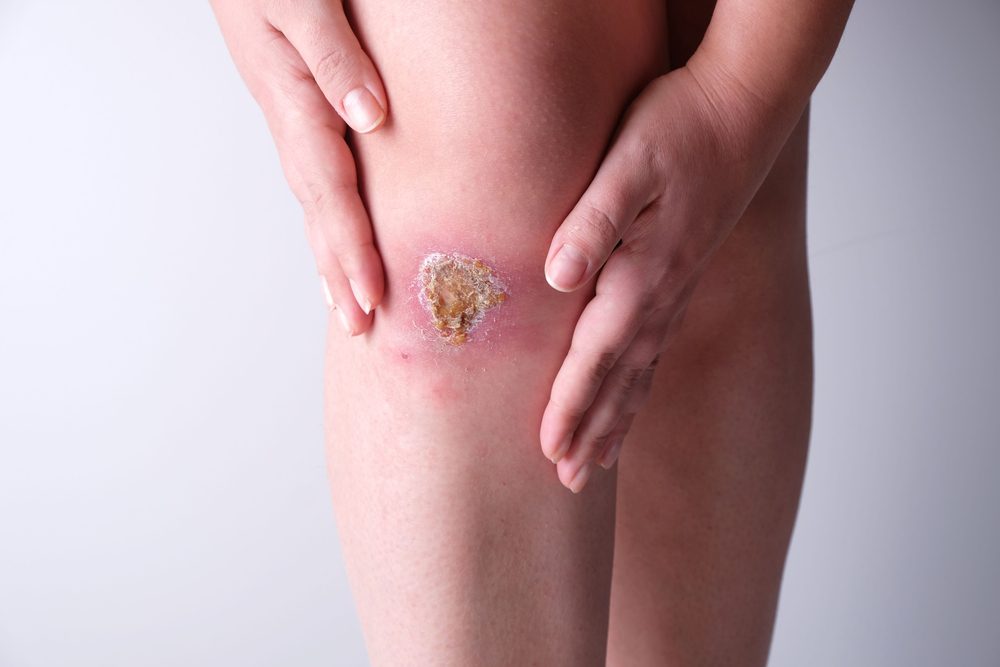 Healing wounds and vitamin C