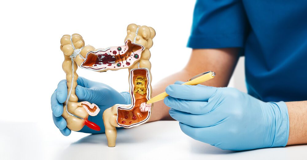 Colon Cancer