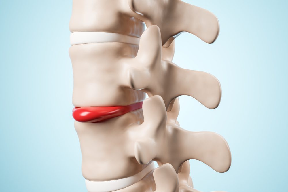 hernias
