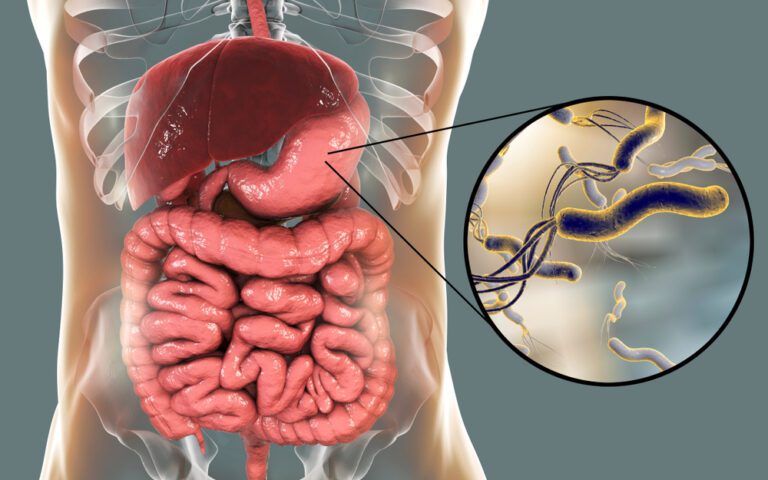 helicobacter pylori