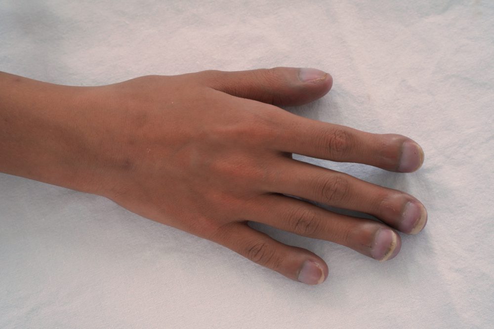 lung cancer