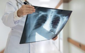 lung cancer