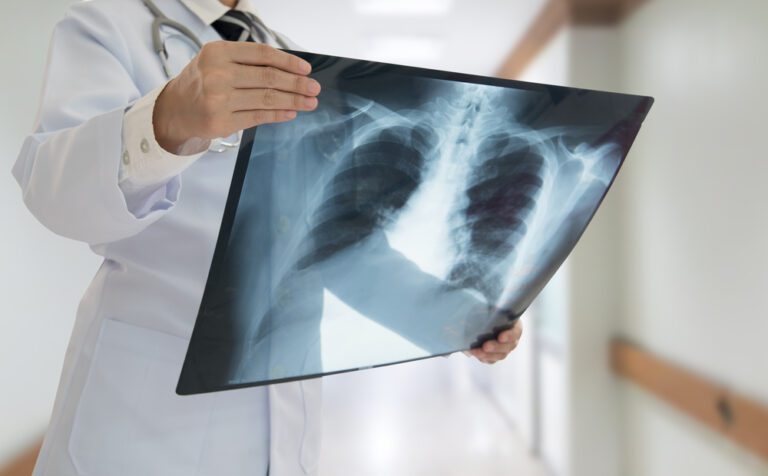 lung cancer