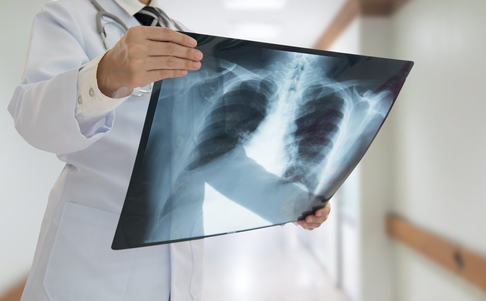 lung cancer