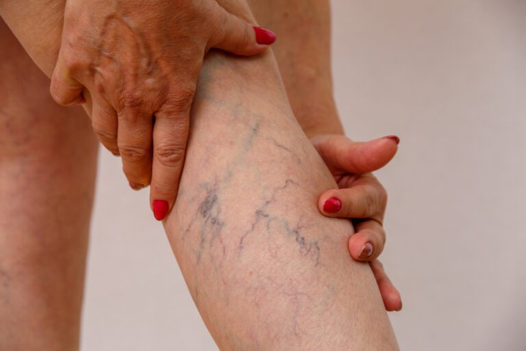 varicose veins