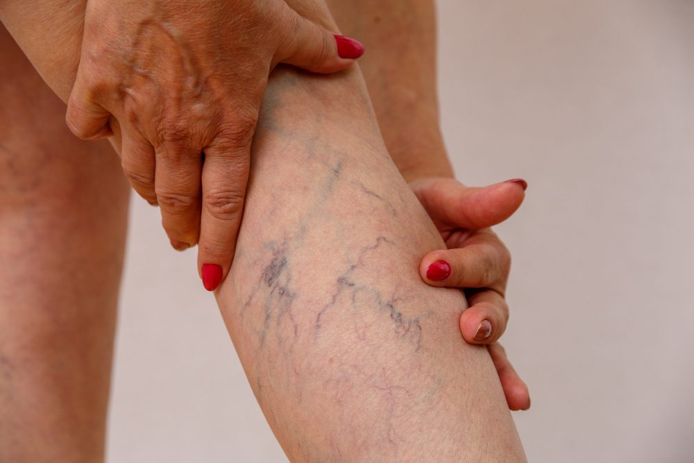 varicose veins