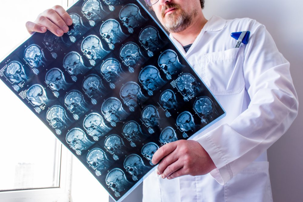 multiple sclerosis