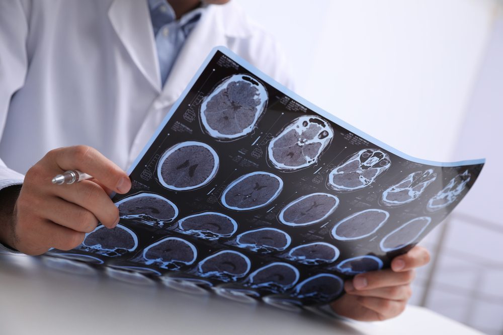 multiple sclerosis