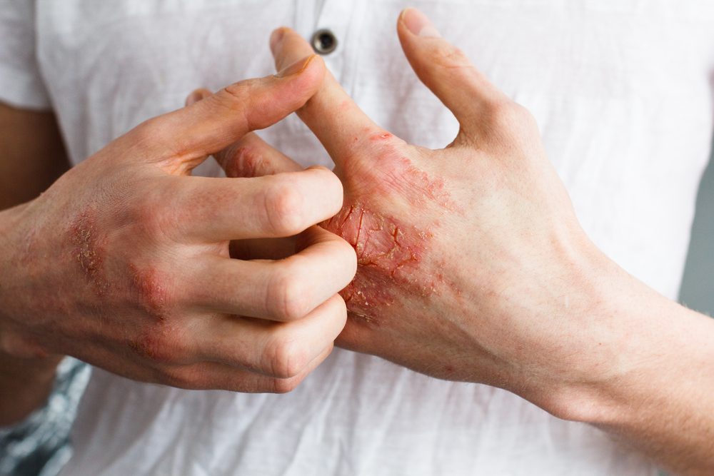 wound