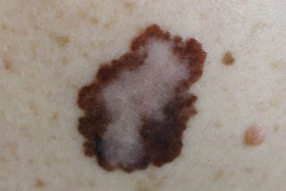 skin