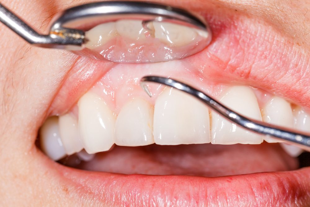 toothache