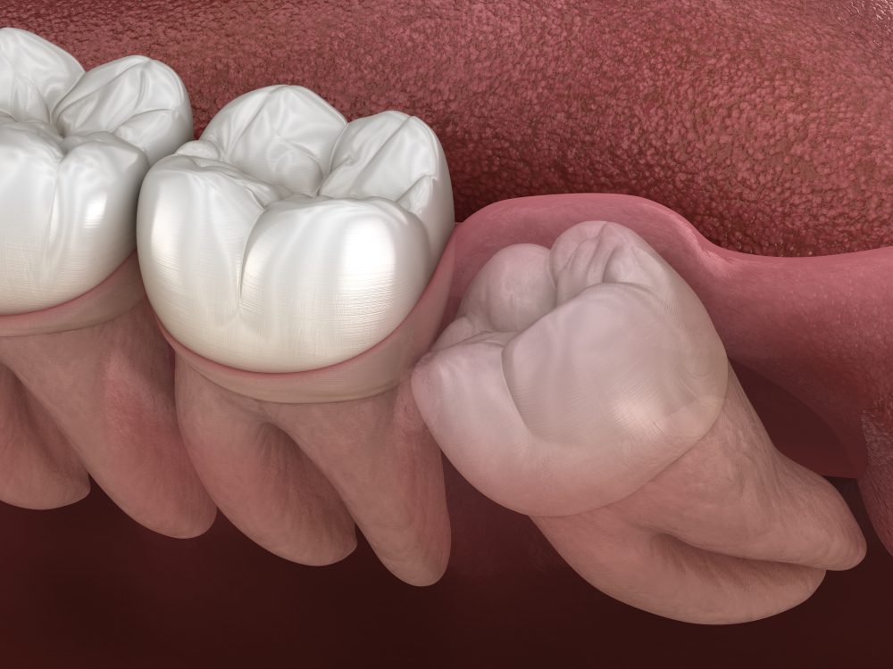 toothache