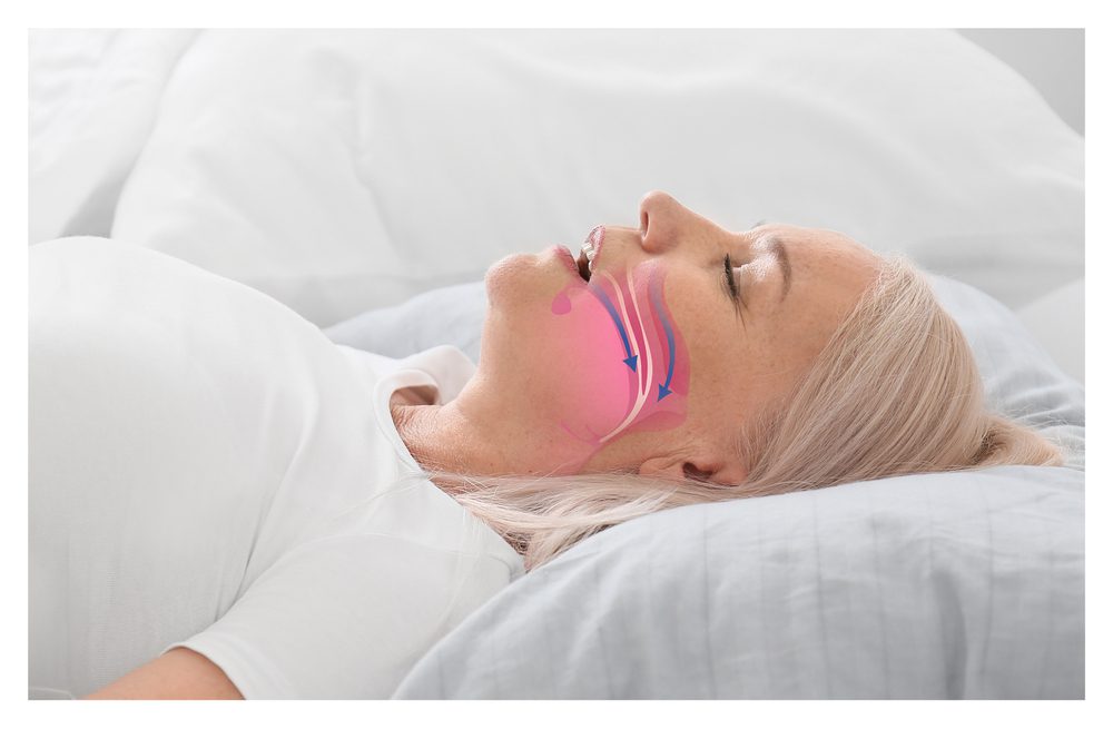 Sleep Apnea