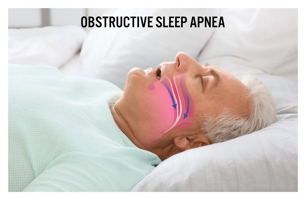 Sleep Apnea