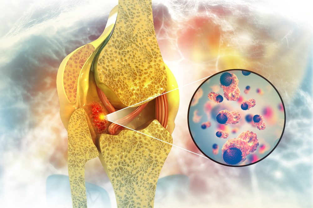 where cancer spreads