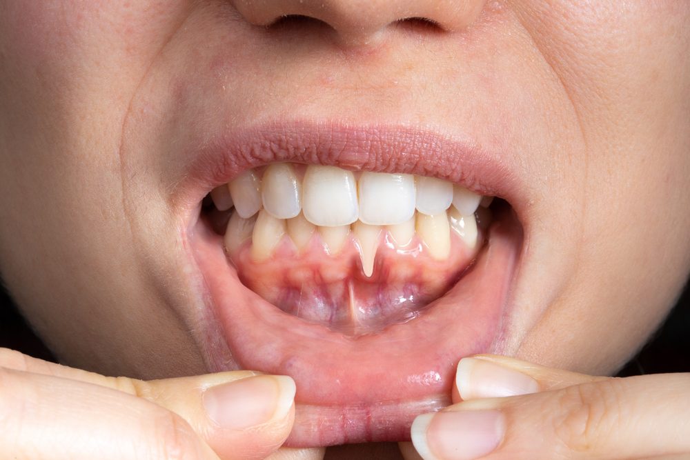 dental implant failure