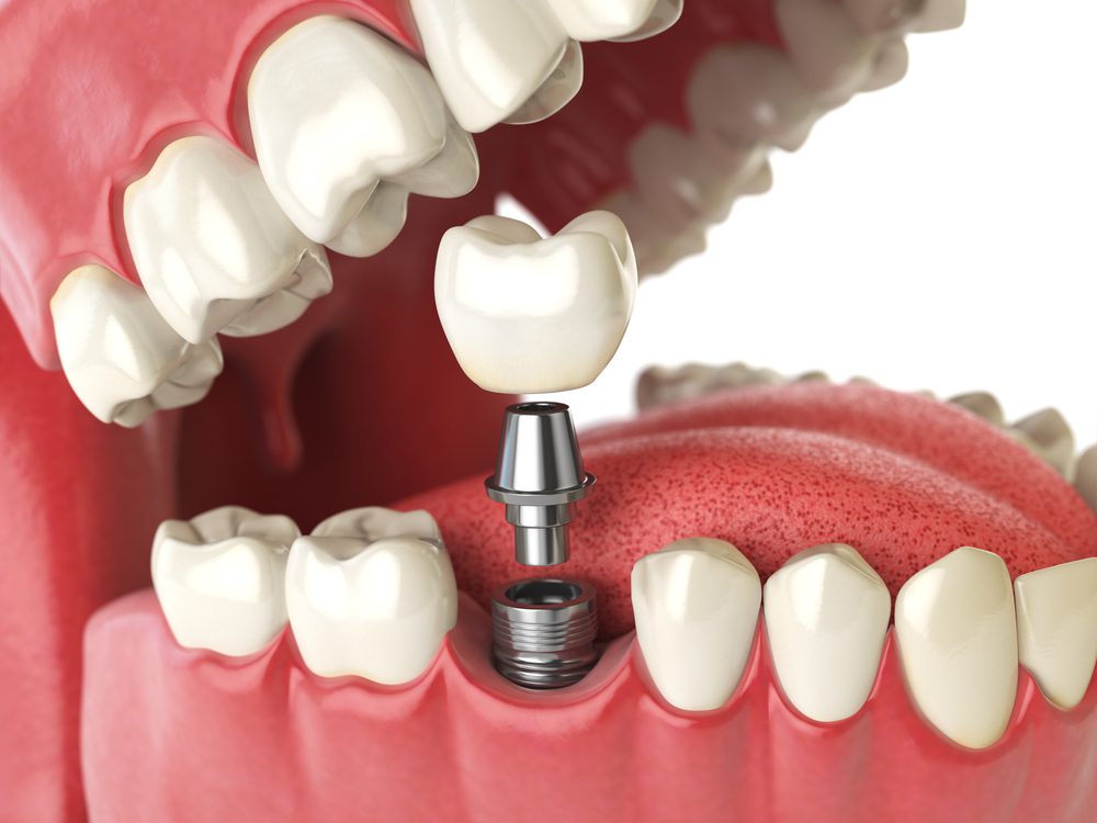 dental implant failure