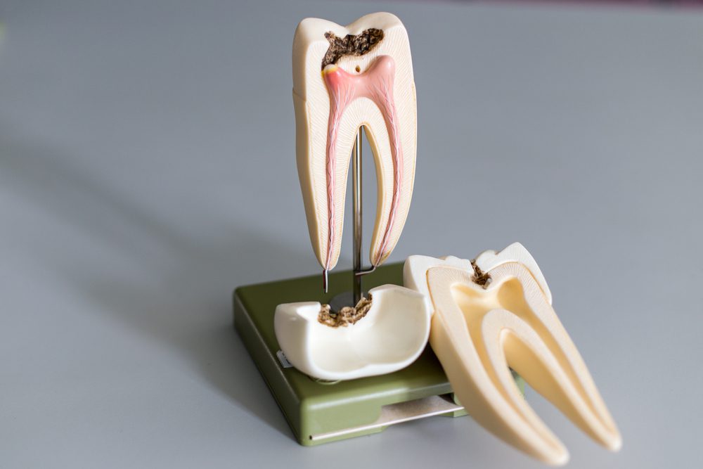 early signs of a root canal