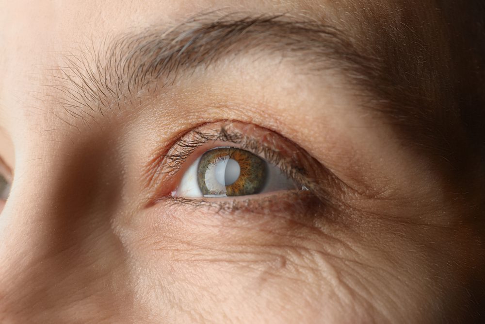 Cataract Surgery Risk