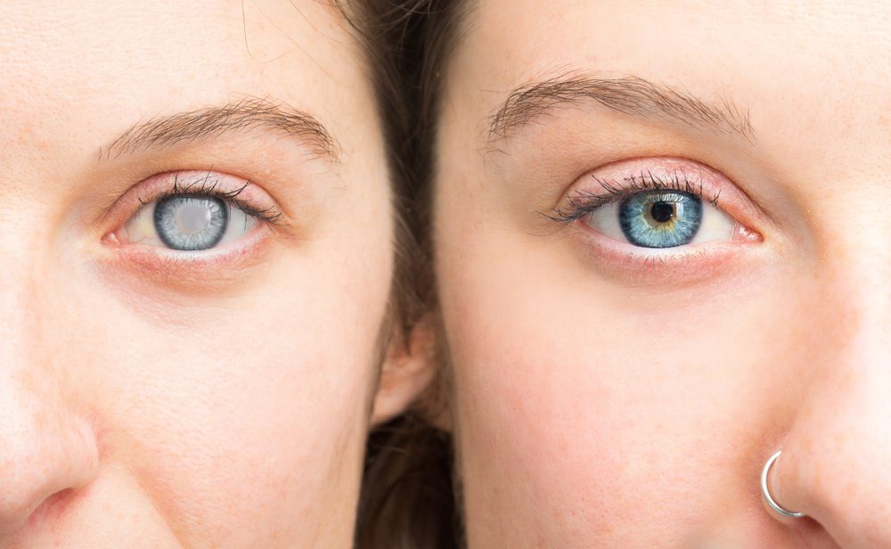 Cataract Surgery Risk