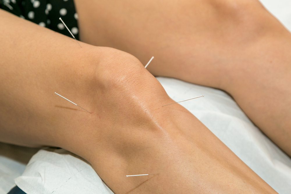 Acupuncture Benefits For Arthritis