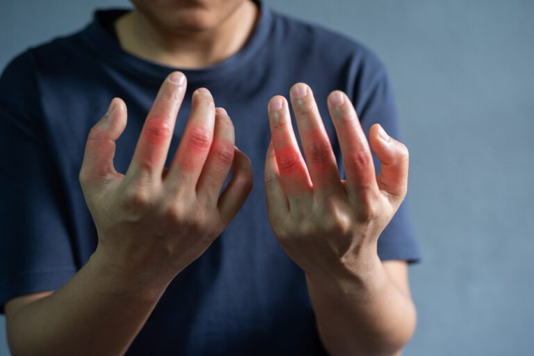 living with rheumatoid arthritis