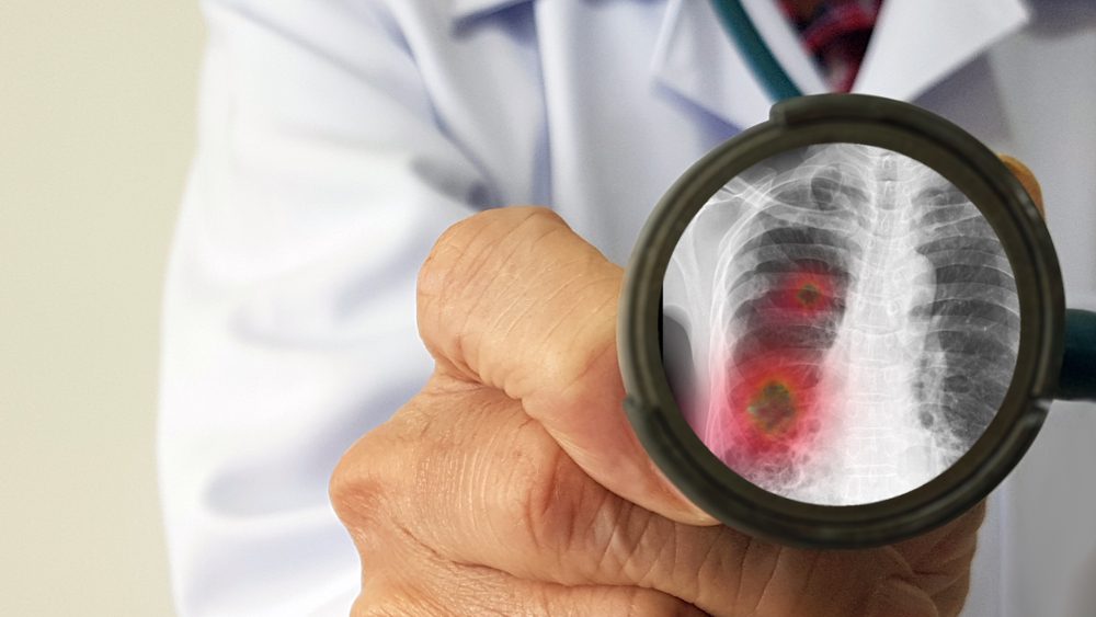 mycoplasma pneumoniae