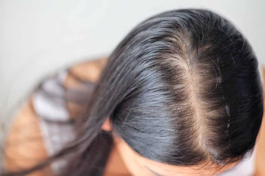 hair loss women