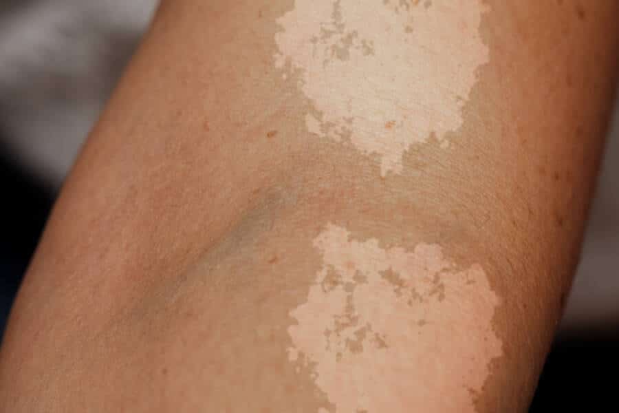 skin fungi
