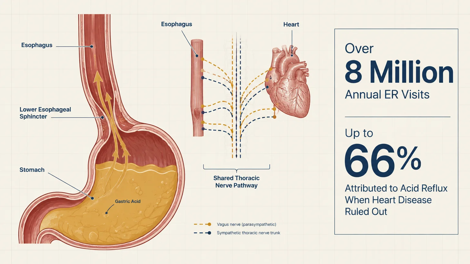 Medical diagram of acid reflux into the esophagus alongside heart nerve pathways and chest pain statistics.