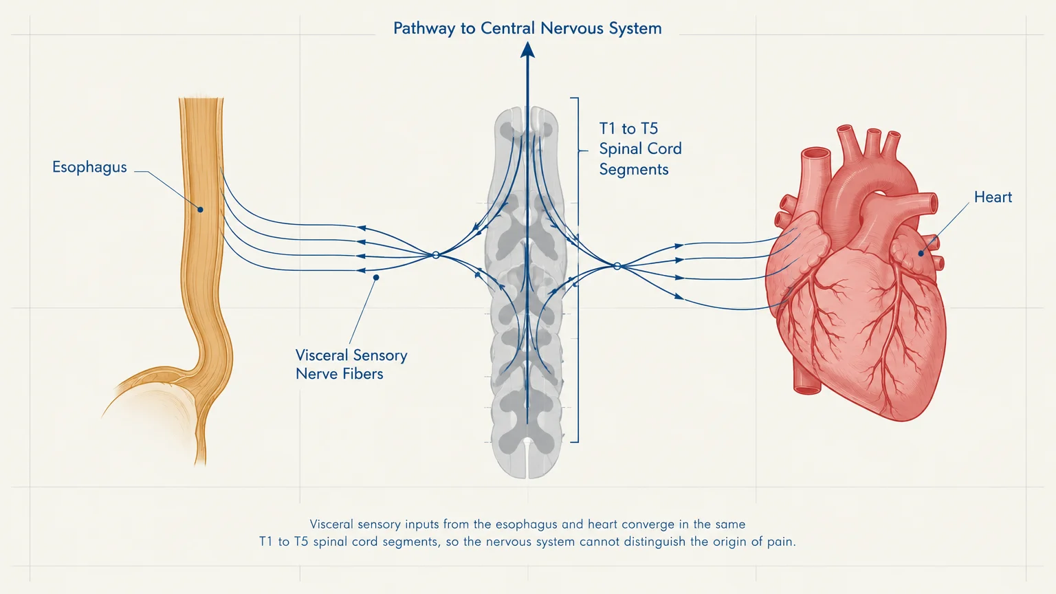 Diagram showing nerve pathways from the esophagus and heart converging at T1 to T5 spinal cord segments toward the brain.